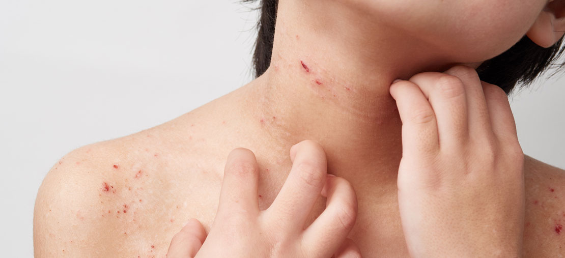 Qu’est-ce qu’une dermatite atopique